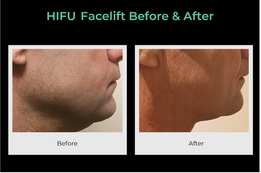 HIFU Facelift in Southampton